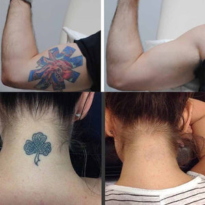 Permanent Tattoo Removal Cream